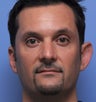 Otoplasty