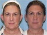 Otoplasty