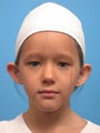 Otoplasty