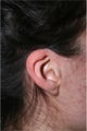 Otoplasty