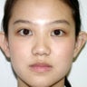 Otoplasty