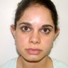 Otoplasty