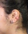Otoplasty