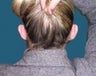 Ear Pinning