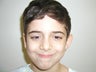 Otoplasty (Ear Correction)
