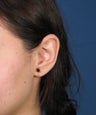 Otoplasty