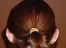Otoplasty/ear pin back