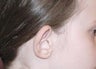 Correction protruding ears