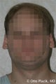 Otoplasty