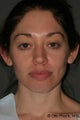 Otoplasty
