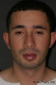 Otoplasty