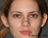 Otoplasty