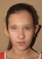 Otoplasty -ear pin back