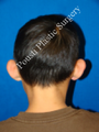 Ear Surgery (Otoplasty)