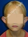 Ear Surgery (Otoplasty)