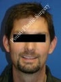 Ear Surgery (Otoplasty)