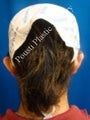 Ear Surgery (Otoplasty)