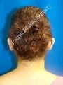 Ear Surgery (Otoplasty)