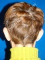 Ear Surgery (Otoplasty)