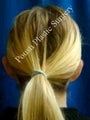 Ear Surgery (Otoplasty)