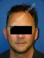 Ear Surgery (Otoplasty)
