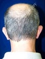 Ear Surgery (Otoplasty)