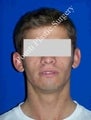 Ear Surgery (Otoplasty)