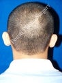 Ear Surgery (Otoplasty)