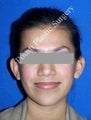 Ear Surgery (Otoplasty)