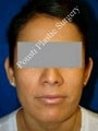 Ear Surgery (Otoplasty)