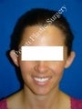 Ear Surgery (Otoplasty)