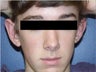 Ear surgery to reshape the ears (otoplasty)