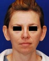 Otoplasty