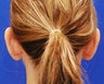 Otoplasty