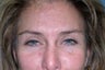 Eyelid Surgery