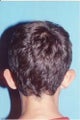 Ear Reshaping