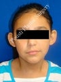 Ear Surgery (Otoplasty)