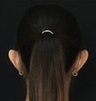 Ear Pinning (Otoplasty)