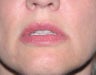 Injectables
