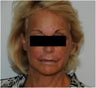 Evolence Injection in Glabella to Reduce Static Wrinkles