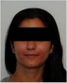 Evolence Injection in Smile Lines