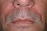 Evolence injections