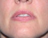 Injectables