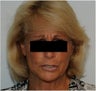 Evolence Injection in Glabella to Reduce Static Wrinkles