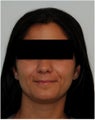 Evolence Injection in Smile Lines