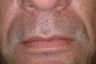 Evolence injections