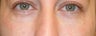 Under eye bag treatment