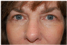 blepharoplasty