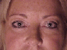 blepharoplasty