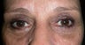 Bilateral upper lid blepharoplasty and Bilateral lower lid blepharoplasty